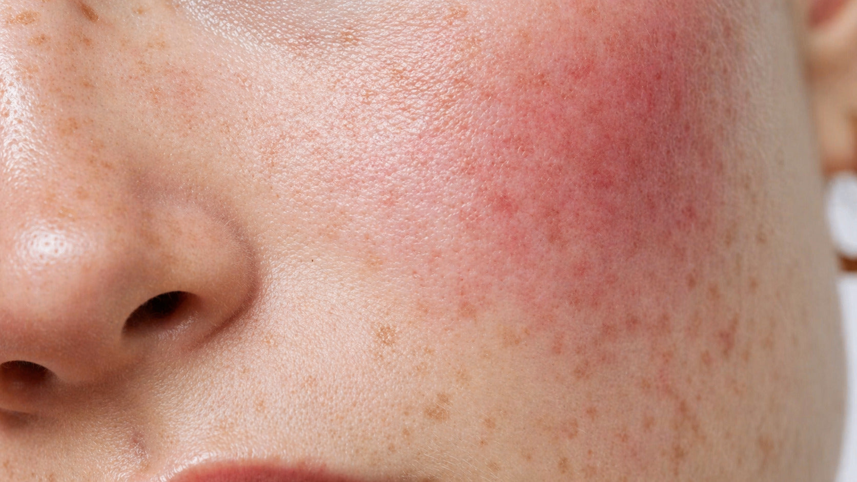 Rosacea
