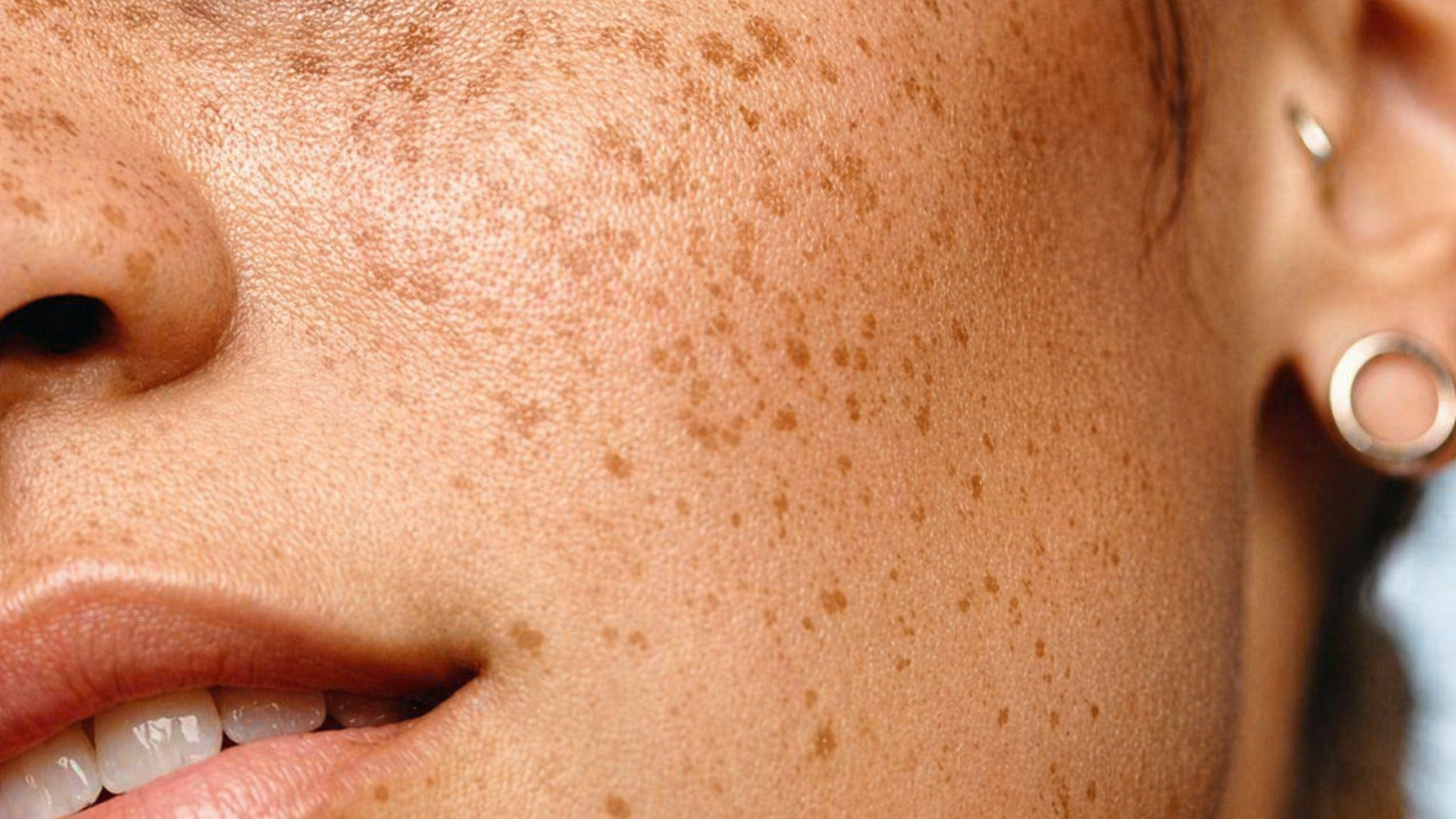 Manchas Y Melasma